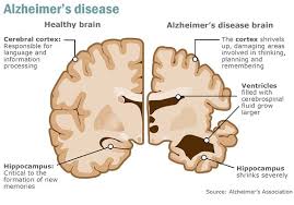 alzheimers study